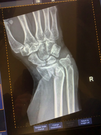 Dec 3 - Definitely shattered and dislocated wrist, 2 broken arm bones. 
I will need surgery.